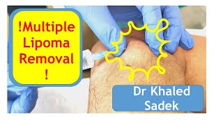 Multilple Lipoma Removal Dr Khaled Sadek London Cyst Clinic [upl. by Yoshi346]