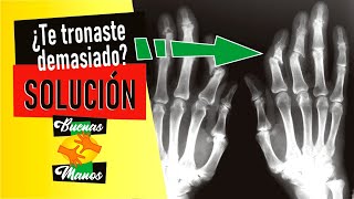 MANOS DEFORMES POR TRONARSE LOS DEDOS  SOLUCIÓN [upl. by Danyette921]