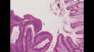 Histopathology ColonTubular adenoma [upl. by Yzzik]