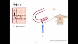 Ischemia Injury and Infarct [upl. by Delos]