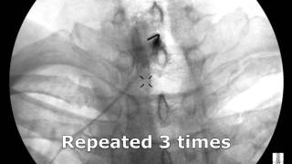 Cervical Interlaminar Epidural Steroid Injection  ThePainSourcecom [upl. by Darnok]