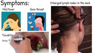 Infectious mononucleosis  Easy explained [upl. by Aneeh457]