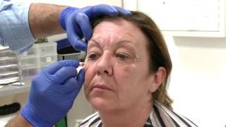 Injecting Botox into the Glabella region  Training Video For Medical Professionals Only [upl. by Hallsy139]