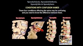 Spondylolysis Spondylolisthesis Spondylitis SpondylosisEverything Need To KnowDr Nabil Ebraheim [upl. by Intruoc814]