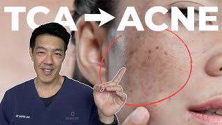 What to consider BEFORE acne scar revision Dermatologist Guide [upl. by Clementis]