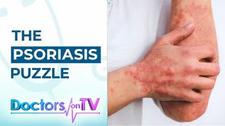 Psoriasis Know the Symptoms Causes and available Treatments from Dermatology Specialist [upl. by Dulcine]