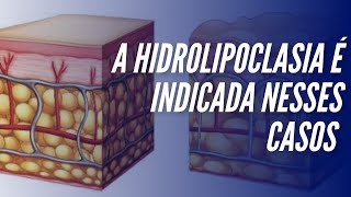 A hidrolipoclasia é indicada nesses casos [upl. by Hevak]