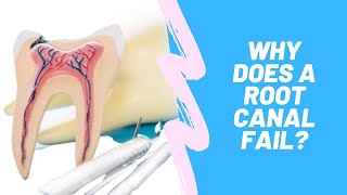 Why Does a Root Canal Fail [upl. by Adnaloj340]