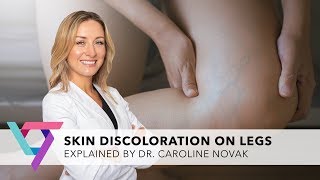 Medical Center Skin Discoloration on Legs  Best Vein Doctor in New York 10016 [upl. by Benedix]