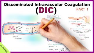 DIC Disseminated Intravascular Coagulation  Part 1 [upl. by Sanez]