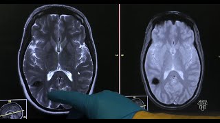 Cavernous malformations — Neurovascular disease explained [upl. by Gwenn]