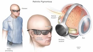 Retinal Prosthesis  Mayo Clinic [upl. by Ernst]