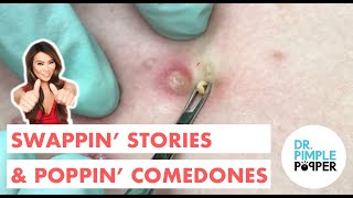 Swappin Stories amp Poppin Comedones [upl. by Elacim]