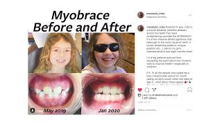 Tool to Stop Mouth Breathing Actually Changed my Kids Face MYOBRACE review [upl. by Sherilyn]