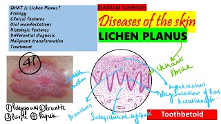 Oral Lichen planus Part 1 Causes Pathogenesis Clinical features Skin lesions [upl. by Aphrodite]