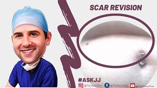 Can an indented scar be removed [upl. by Auop]