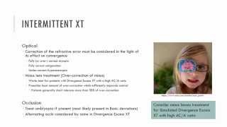 Intermittent Exotropia Management [upl. by Vachil705]