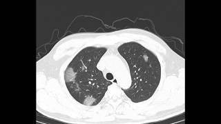 Chest CT findings in COVID19 [upl. by Kotz]