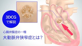 3DCGで解説！心臓弁膜症の一種「大動脈弁狭窄症」とは [upl. by Ordnazil]