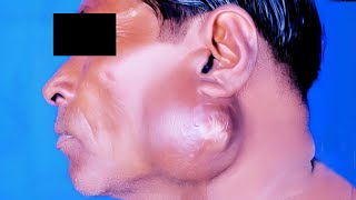 Tuberculous Abscess of Parotid Gland [upl. by Ylram492]