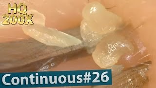 26 Continuous Removal of Blackheads Close up 200X  Squeezing Blackheads [upl. by Cogen]