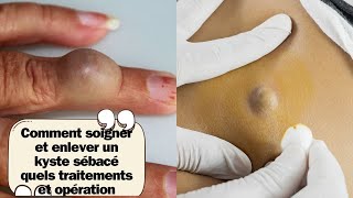 Comment soigner et enlever un kyste sébacé quels traitements et opération [upl. by Imot941]