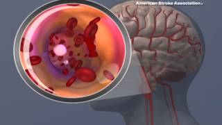 Ischemic Stroke Animation [upl. by Old]