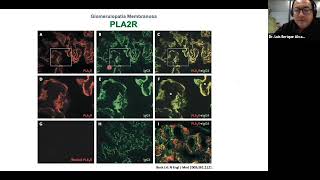 Nefropatia Membranosa Dr alvarez [upl. by Ardnalak181]