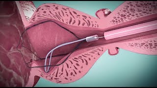 ITIND procedure 3D animation by MediTate [upl. by Drobman]