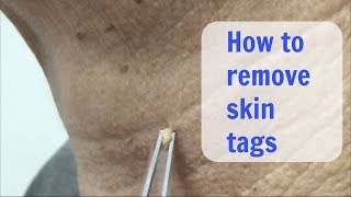 Painless Cryo Skin Tags removal  Cosmetic Institute of Australia [upl. by Llennaj]