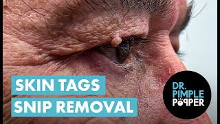 Acrochordon Snip Removal Dr Pimple Popper REMOVES Skin Tags Near Eyes [upl. by Lehcir]