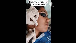 Removal of mole by radiofrequency I Skin Care [upl. by Naesed]