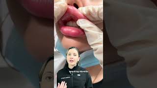 What are the risk of overfilled lip filler Dr Medispa [upl. by Burrill]