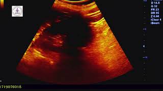 ULTRASOUND OF KIDNEY HANDS ON TRAINING [upl. by Sirdi]