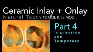 Lithium Disilicate Ceramics Part 4 Impression and Temporary [upl. by Reviere]