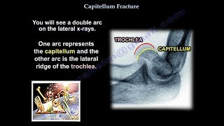 Capitellum Fracture  Everything You Need To Know  Dr Nabil Ebraheim [upl. by Enair]