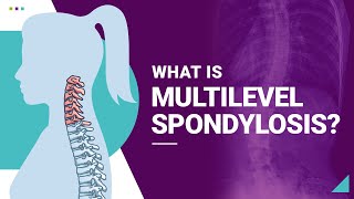 What is Multilevel Spondylosis [upl. by Lord57]