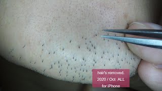 Extractions Unwanted Hair l Tweezers Beard l 20201111 [upl. by Dena]