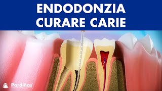 Endodonzia – Curare carie profonda © [upl. by Lirrehs]