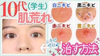 【思春期】生理が来るとニキビが出る？！ニキビを治す方法＆私のスキンケア法伝授！【ニキビの種類原因対処法】 [upl. by Andriette]