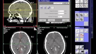 CT de craniomultslice [upl. by Bui]