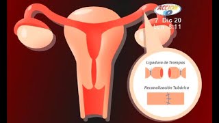 Recanalización de las Trompas de Falopio [upl. by Aicercal]