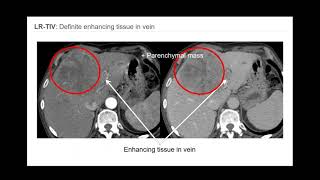 3 LIRADS Overview of CTMR algorithm and major features  Part 1 By Dr Victoria Chernyak [upl. by Patty114]