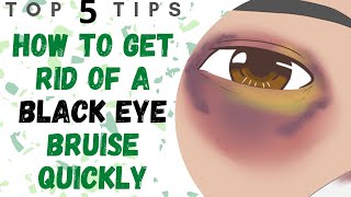 How To Get Rid Of A Black Eye Bruise Quickly  Black Eye Cover Up [upl. by Maite]