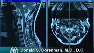 How to Read a MRI of the Normal Cervical Spine Neck  Colorado Spine Expert [upl. by Laing]