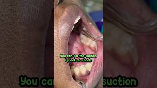 suction tip trick and hack in moisture control management independently without assistant dental [upl. by Yaja]