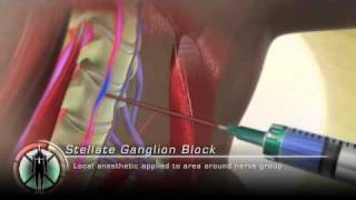 Stellate Ganglion Block Injection [upl. by Tnaryb]