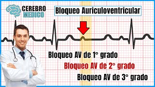 Bloqueos Auriculoventricualres BLOQUEOS AV de 1° 2° y 3°  ▷ Como leer un EKG paso a paso [upl. by Cumine]