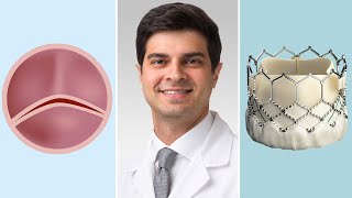 Bicuspid Aortic Valves Surgical amp Transcatheter Aortic Valve Replacement Options for Patients [upl. by Nimzzaj238]