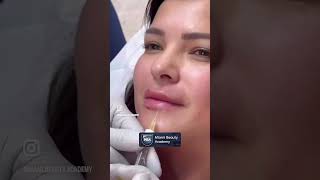 Lip fillers  100 hyaluronic acid [upl. by Landing]